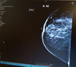 ab-mammogram_web-300x26413